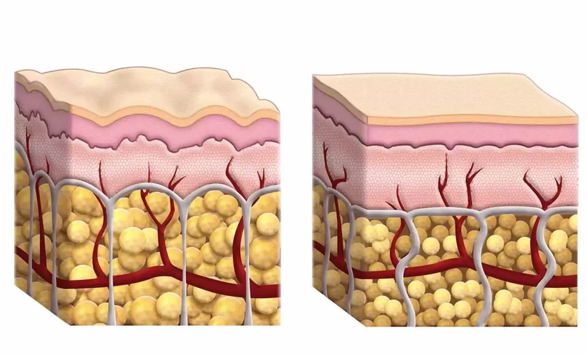Fat cells during the use of keto guru