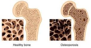 Osteoporosis of bones